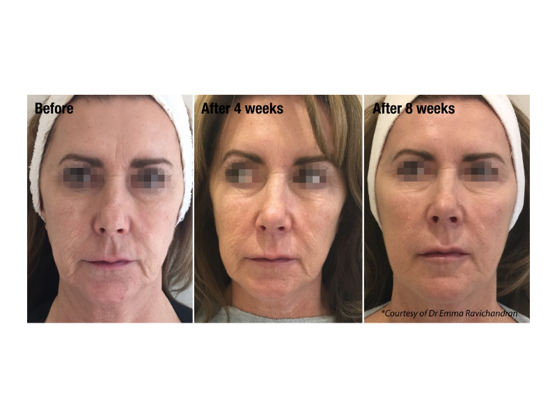 profhilo-leeds-advanced-skin-rejuvenation-treatment-small-0
