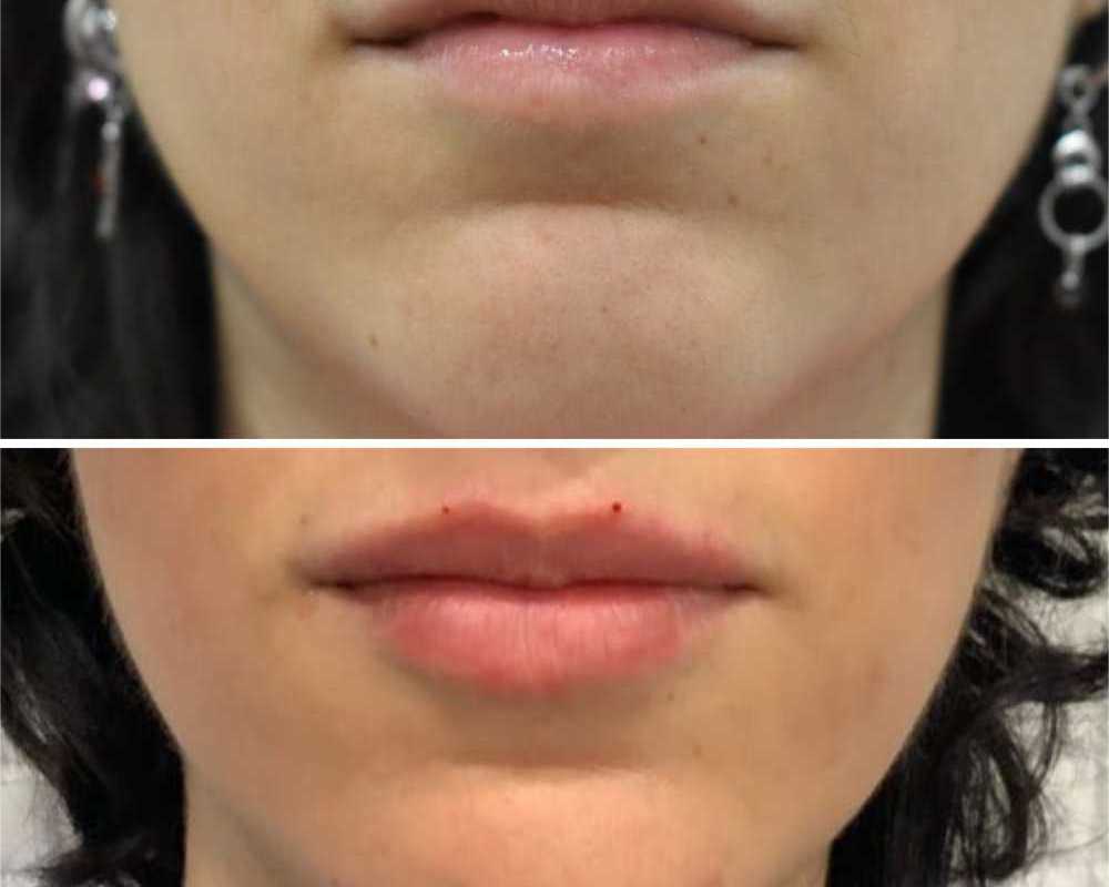8-point-liquid-facelift-non-surgical-facial-rejuvenation