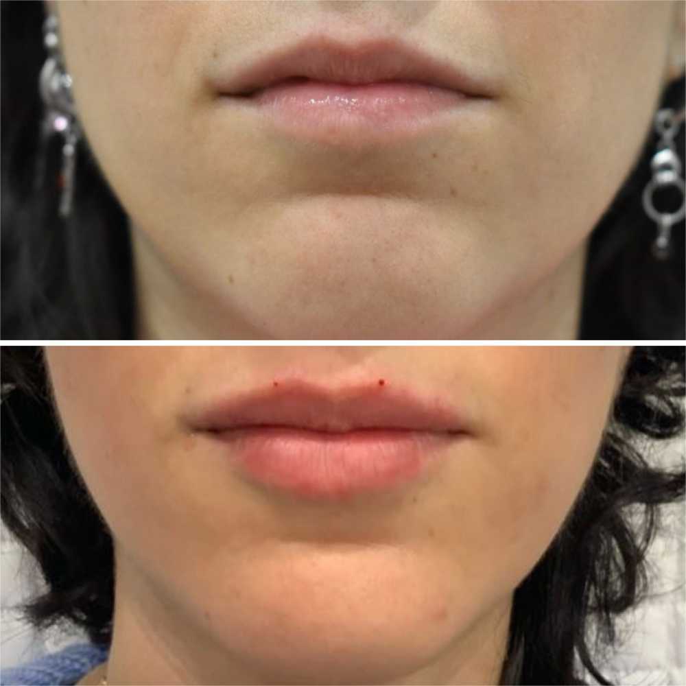 8-point-liquid-facelift-non-surgical-facial-rejuvenation-big-0