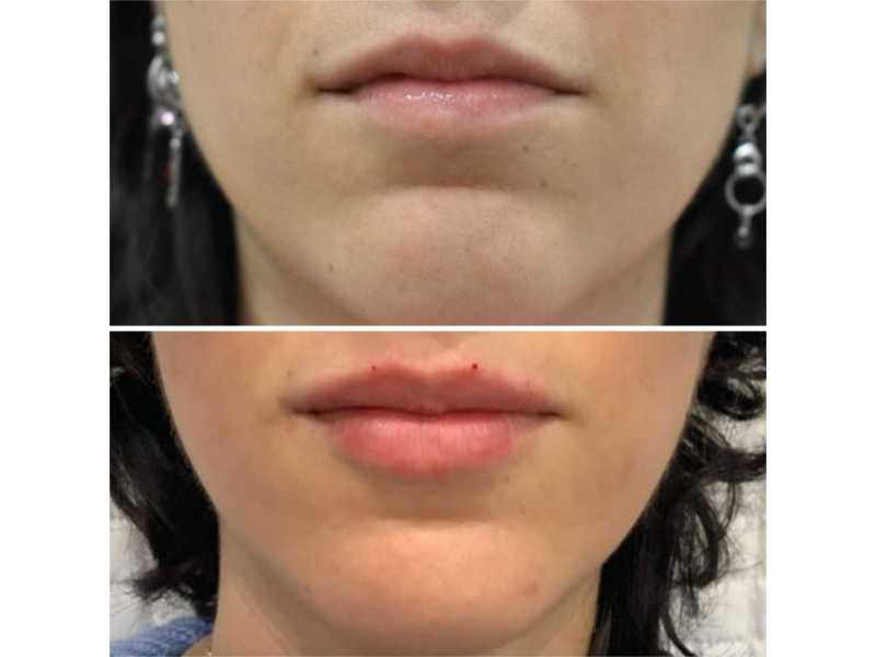 8-point-liquid-facelift-non-surgical-facial-rejuvenation-small-0