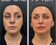 facial-rejuvenation-advanced-non-surgical-skin-enhancement