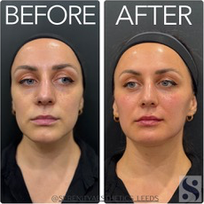 facial-rejuvenation-advanced-non-surgical-skin-enhancement-big-0