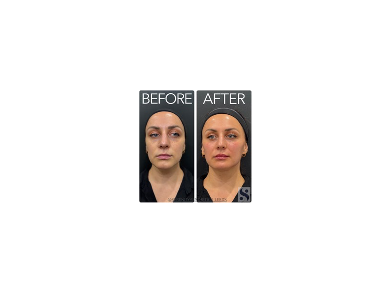 facial-rejuvenation-advanced-non-surgical-skin-enhancement-small-0