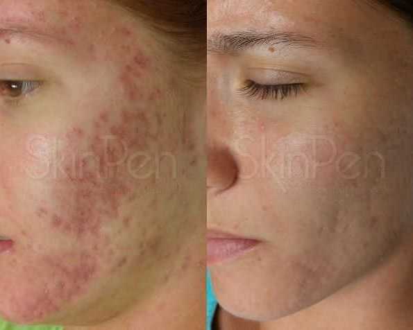 skinpen-microneedling-advanced-skin-resurfacing-treatment