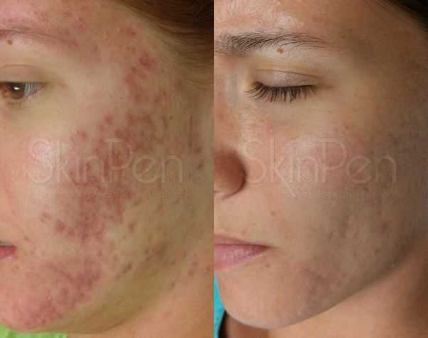 skinpen-microneedling-advanced-skin-resurfacing-treatment-big-0