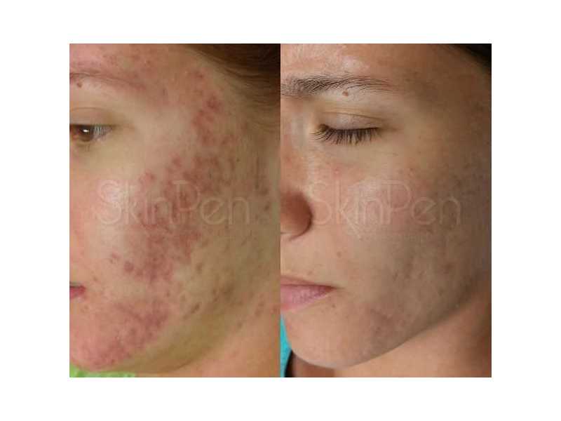 skinpen-microneedling-advanced-skin-resurfacing-treatment-small-0