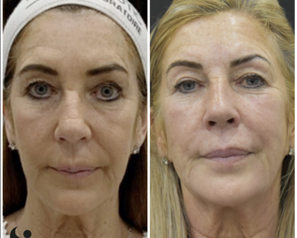 radio-frequency-skin-tightening-non-surgical-firming-and-rejuvenation