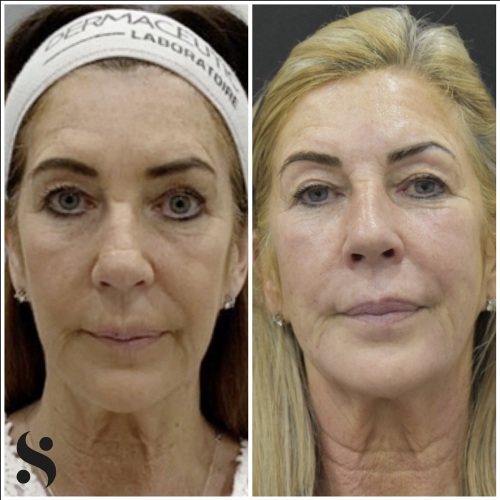 radio-frequency-skin-tightening-non-surgical-firming-and-rejuvenation-big-0