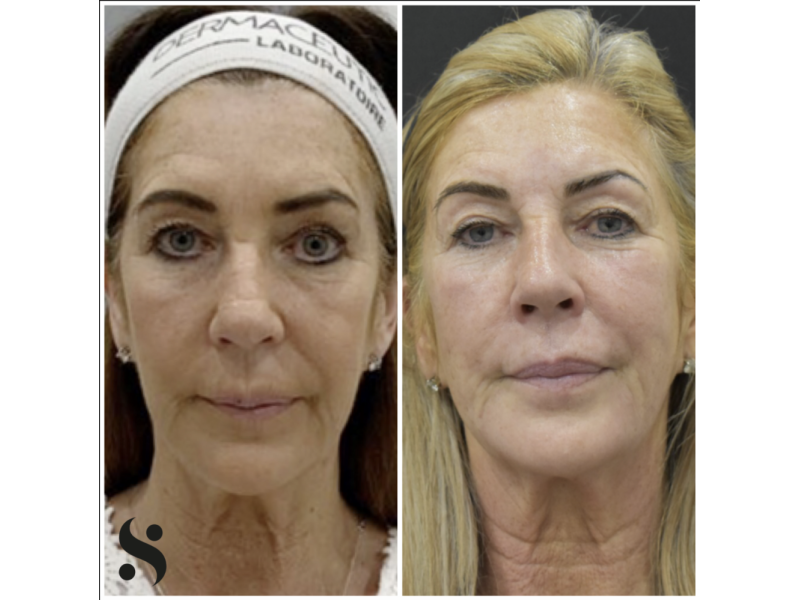radio-frequency-skin-tightening-non-surgical-firming-and-rejuvenation-small-0