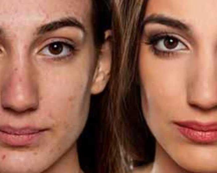 enhance-your-profile-with-non-surgical-rhinoplasty-chiswick