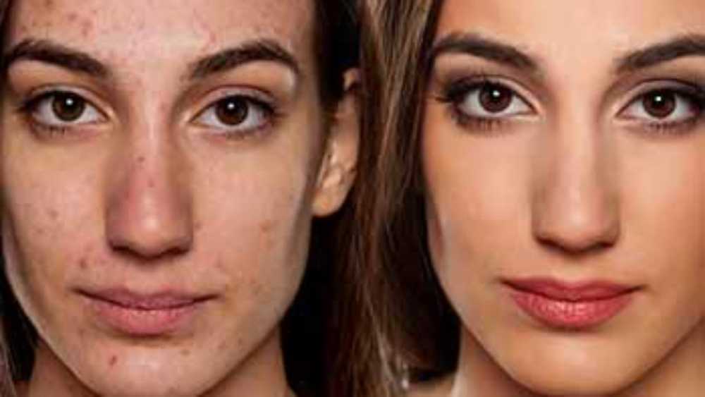 enhance-your-profile-with-non-surgical-rhinoplasty-chiswick-big-0