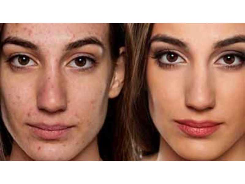 enhance-your-profile-with-non-surgical-rhinoplasty-chiswick-small-0