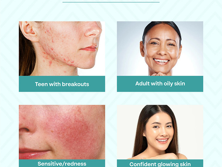 dr-sakhiyas-acne-care-kit-best-skin-care-kit-for-acne-prone-skin-dermatologist-recommended-big-2