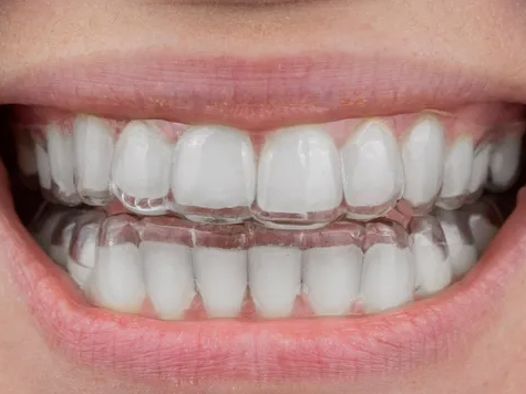 invisible-clear-teeth-aligners-for-effortless-alignment-big-0