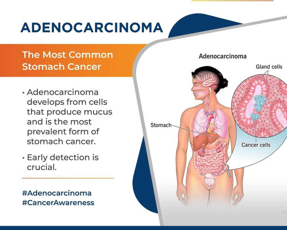 advanced-stomach-cancer-treatment-in-ahmedabad-for-all-stages