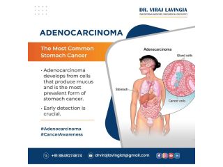 advanced-stomach-cancer-treatment-in-ahmedabad-for-all-stages-small-0