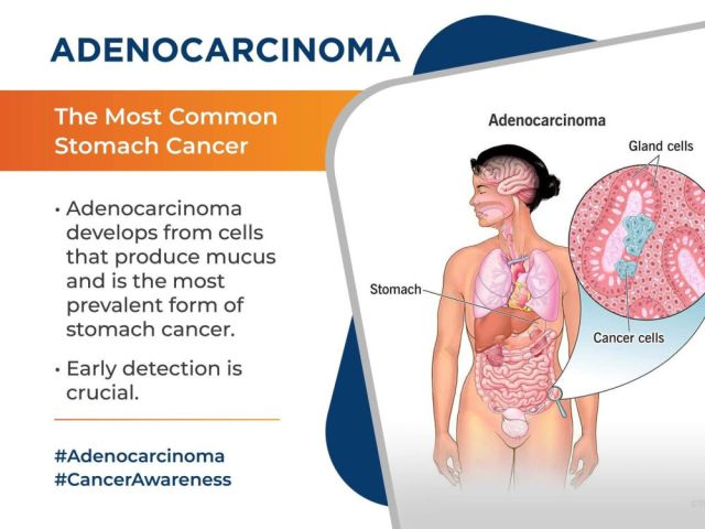 advanced-stomach-cancer-treatment-in-ahmedabad-for-all-stages