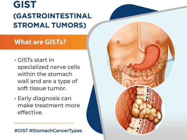 personalised-stomach-cancer-treatment-in-ahmedabad-by-dr-viraj-lavingia