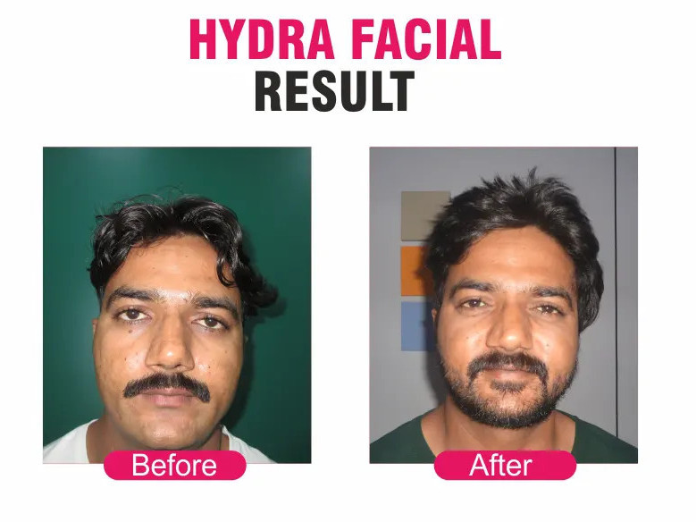 best-skin-laser-hair-clinic-in-pune-sakhiya-skin-clinic-big-4