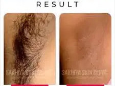 best-skin-laser-hair-clinic-in-pune-sakhiya-skin-clinic-big-2