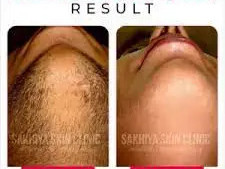 best-skin-laser-hair-clinic-in-pune-sakhiya-skin-clinic-big-3