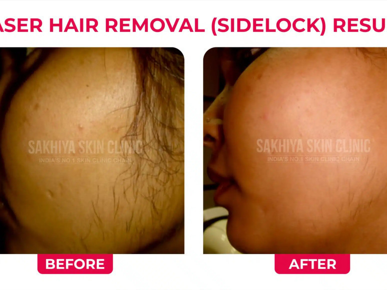 best-skin-laser-hair-clinic-in-pune-sakhiya-skin-clinic-big-1