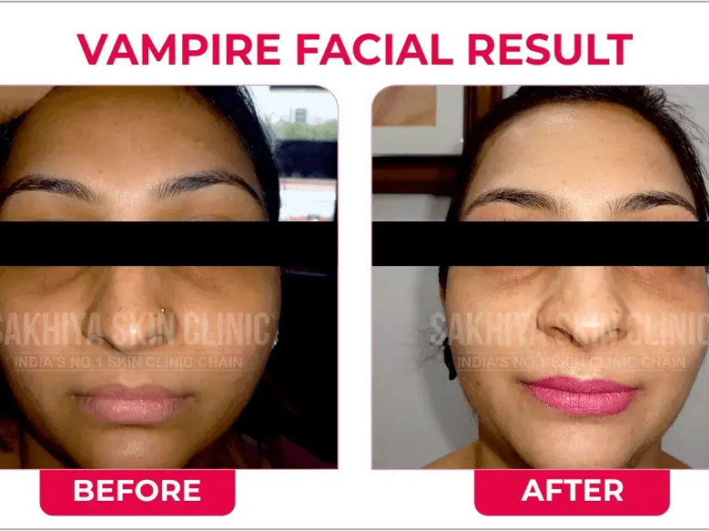 best-skin-laser-hair-clinic-in-pune-sakhiya-skin-clinic-big-0