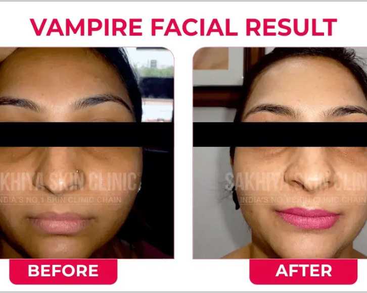 best-skin-laser-hair-clinic-in-pune-sakhiya-skin-clinic