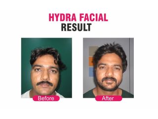best-skin-laser-hair-clinic-in-pune-sakhiya-skin-clinic-small-4