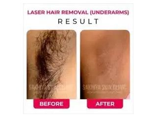 best-skin-laser-hair-clinic-in-pune-sakhiya-skin-clinic-small-2