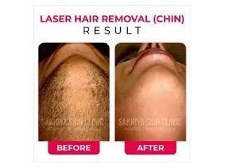 best-skin-laser-hair-clinic-in-pune-sakhiya-skin-clinic-small-3