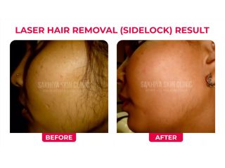 best-skin-laser-hair-clinic-in-pune-sakhiya-skin-clinic-small-1