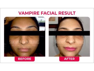 best-skin-laser-hair-clinic-in-pune-sakhiya-skin-clinic-small-0