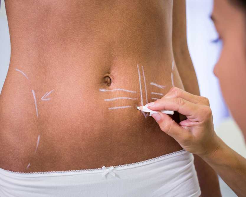 get-the-body-you-deserve-with-liposuction-surgery-in-delhi-and-ncr