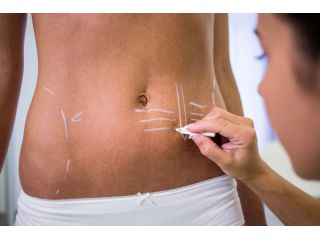 get-the-body-you-deserve-with-liposuction-surgery-in-delhi-and-ncr-small-0
