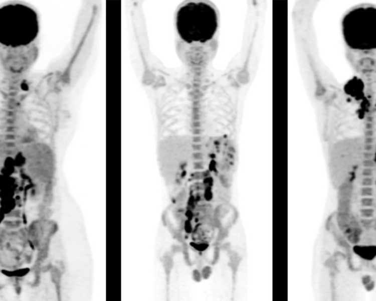 advanced-pet-scan-in-mumbai-for-accurate-cancer-diagnosis-picture-this-imaging