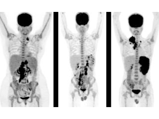 advanced-pet-scan-in-mumbai-for-accurate-cancer-diagnosis-picture-this-imaging-small-0