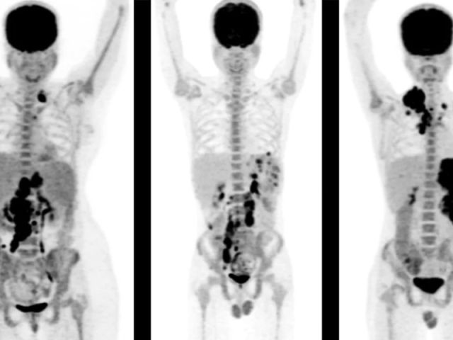advanced-pet-scan-in-mumbai-for-accurate-cancer-diagnosis-picture-this-imaging
