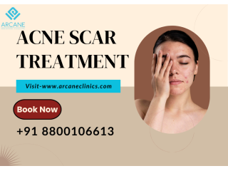 get-advanced-acne-scar-treatment-in-noida-small-0