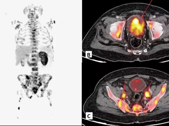 precision-fapi-pet-ct-imaging-for-early-detection-picture-this-imaging