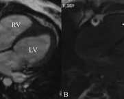 precise-heart-mri-services-for-accurate-cardiac-care-picture-this-imaging
