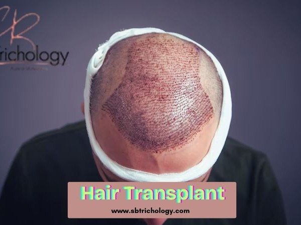 find-the-right-clinic-hair-transplant-in-gurgaon-big-0