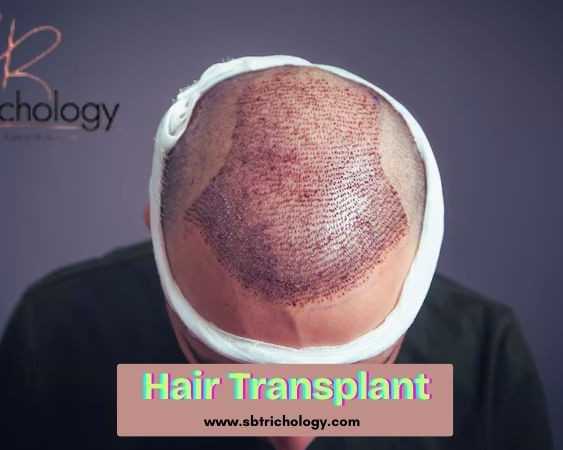 find-the-right-clinic-hair-transplant-in-gurgaon