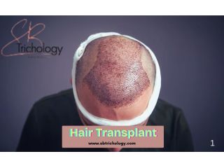 find-the-right-clinic-hair-transplant-in-gurgaon-small-0