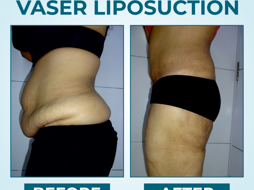 vaser-liposuction-advanced-body-contouring-for-precision-fat-removal-big-1
