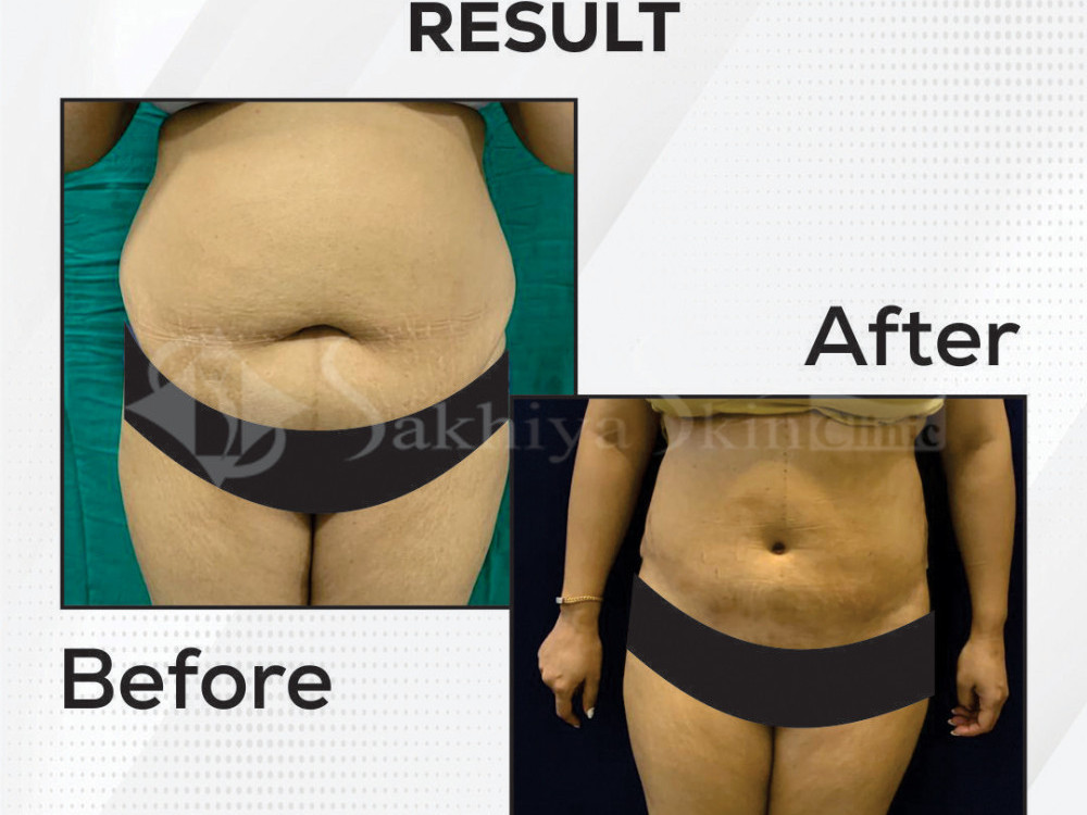 vaser-liposuction-advanced-body-contouring-for-precision-fat-removal-big-2