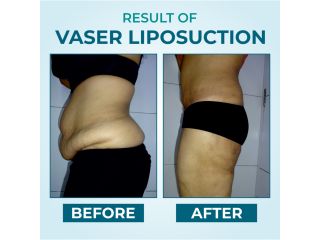 vaser-liposuction-advanced-body-contouring-for-precision-fat-removal-small-1
