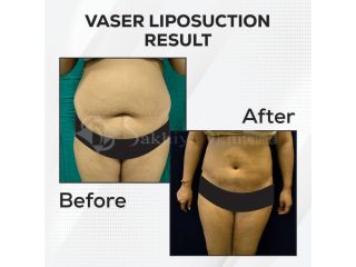 vaser-liposuction-advanced-body-contouring-for-precision-fat-removal-small-2