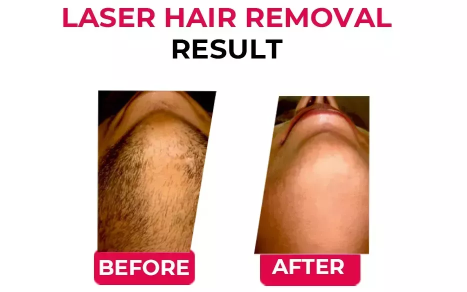 best-laser-hair-removal-treatment-in-india-big-1