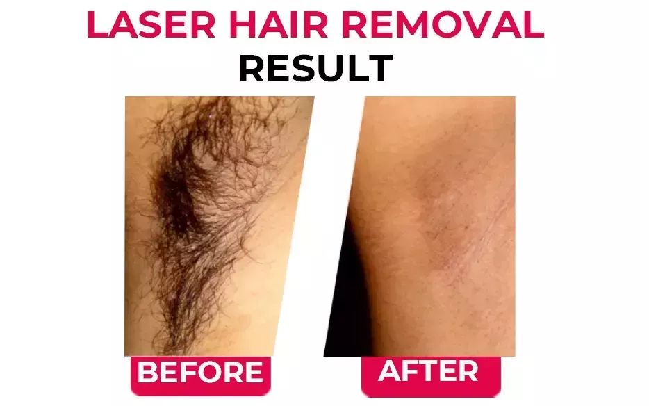 best-laser-hair-removal-treatment-in-india-big-2